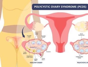 polycystic ovarian syndrome