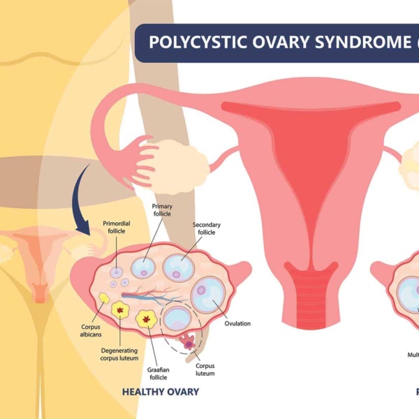 polycystic ovarian syndrome