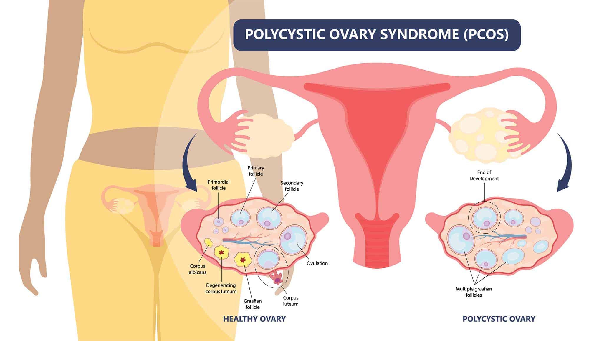 polycystic ovarian syndrome